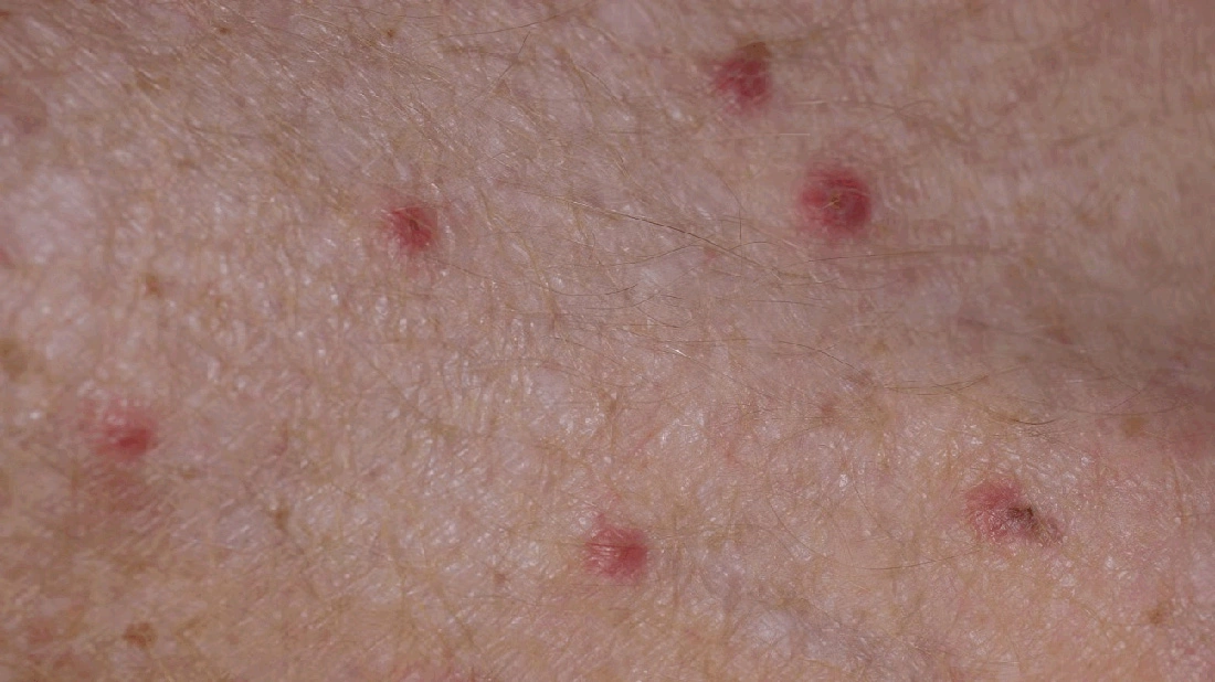 حساسیت به مایت